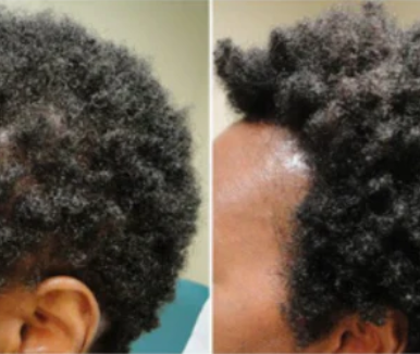 Huile Batana Pure® : Boosteur de Croissance Pour Femme et Homme